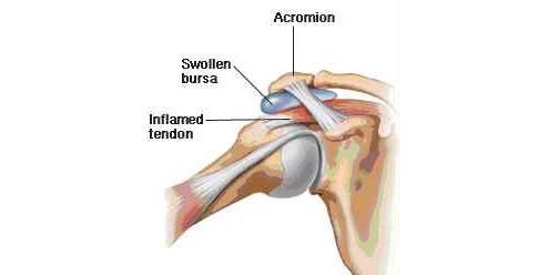 Indeklemningssyndrom illustration